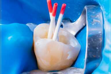 sötétebb fog gyökérkezelés után