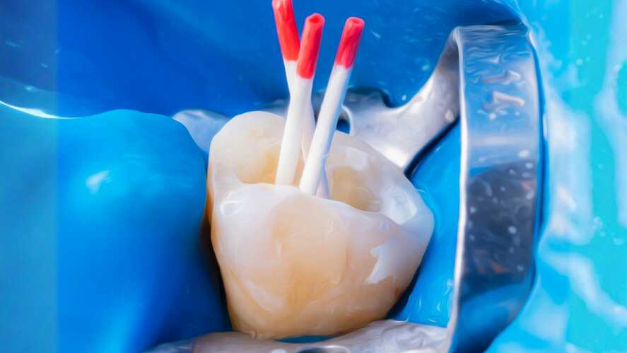 sötétebb fog gyökérkezelés után