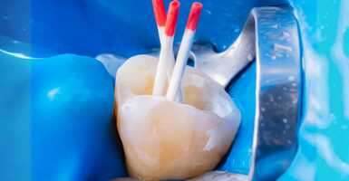 sötétebb fog gyökérkezelés után