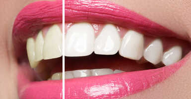 professzionális fogfehérítés